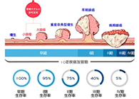 直腸癌早篩試劑盒“第一證”—足不出戶而明察秋毫