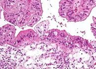 【Science速遞】“沉默的殺手”卵巢癌的治療新靶點終于被發現了
